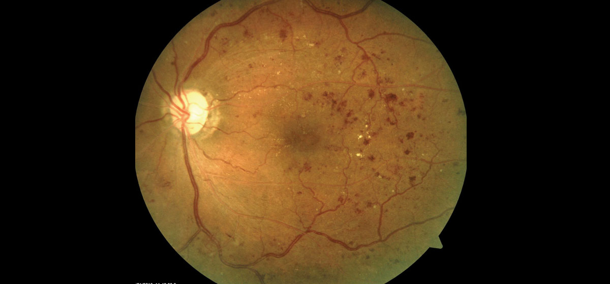 Diabetic Retinopathy