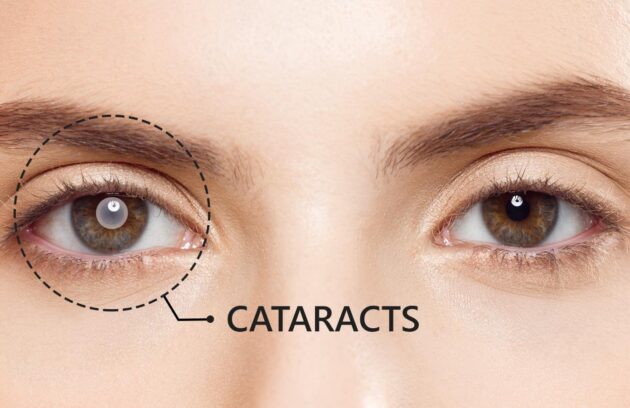 Cataracts-1