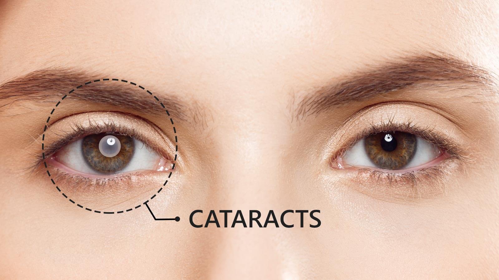 Cataracts-1