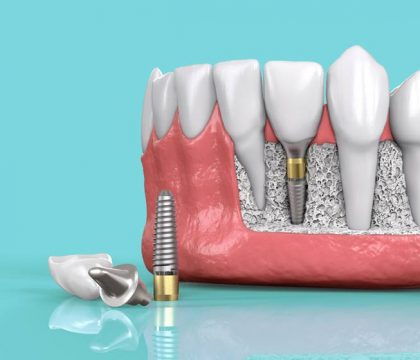 Dental Implant Model