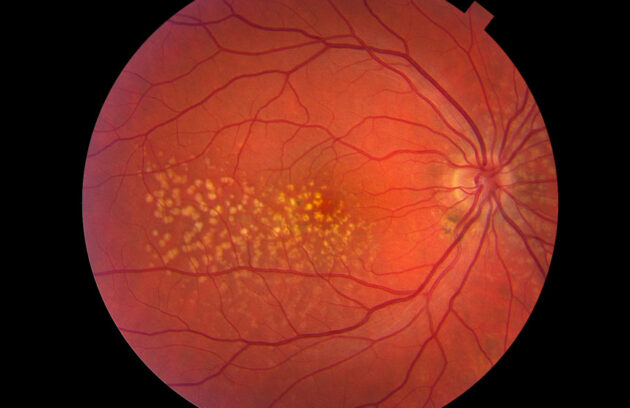 Macular Degeneration