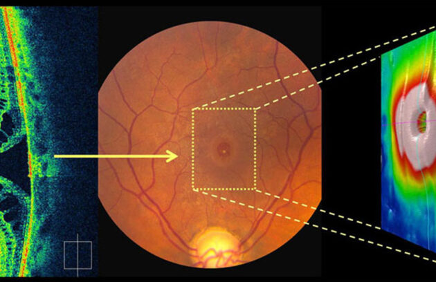 Macular Hole