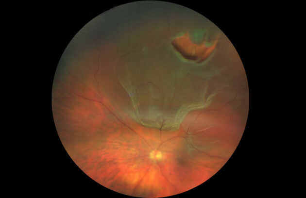 Retinal Tears and Detachment