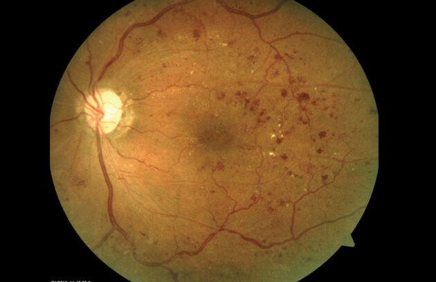 Diabetic Retinopathy