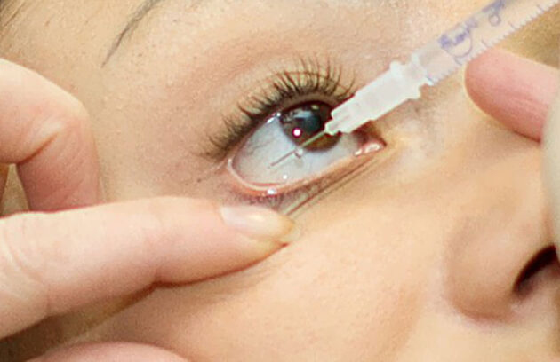 Retinal Injections
